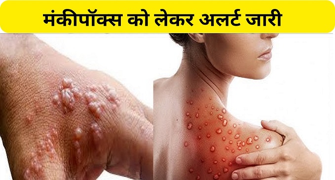 Alert in Bihar regarding monkeypox